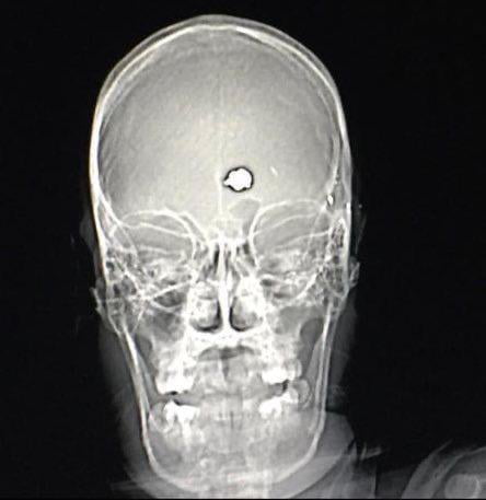 In the 80s patient u201cGeorgeu201d with severe OCD shot himself in the head attempting suicide. Rather than killing him, the bullet destroyed the part of his brain responsible for OCD.
