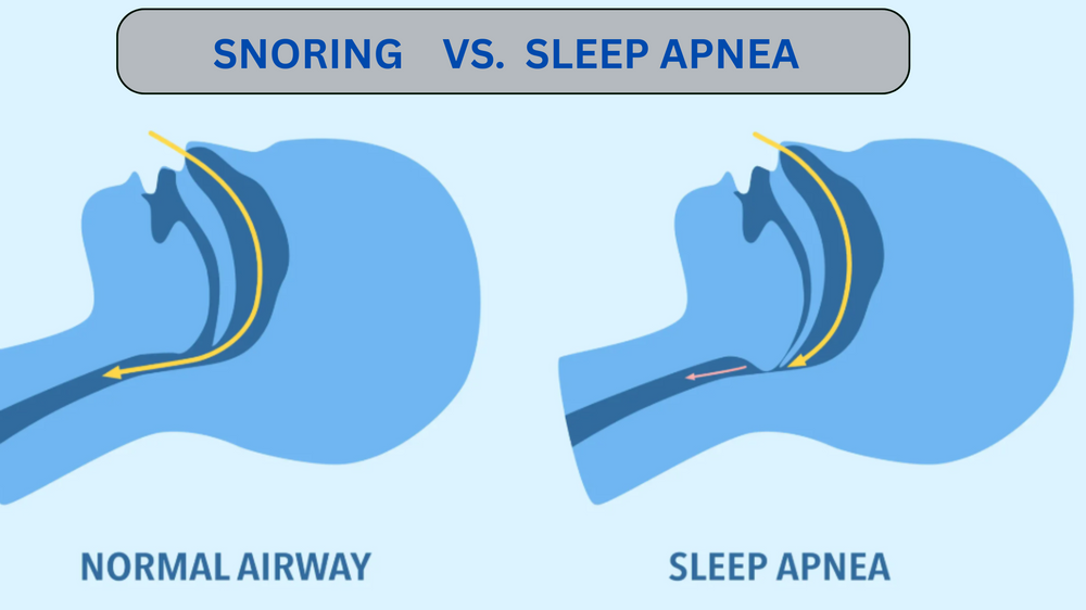 Snoring vs. Sleep Apnoea: When Should You See a Sleep Doctor in Singapore?
