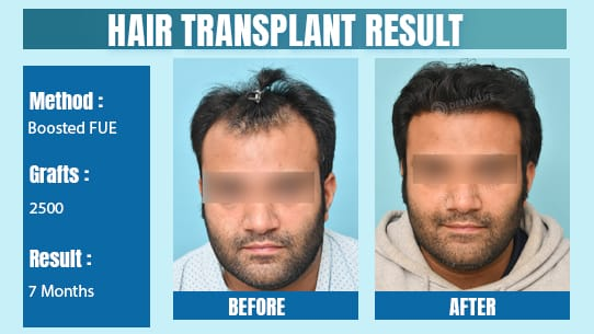 Hair Transplant in Delhi: Understanding Shock Loss – Temporary vs. Permanent